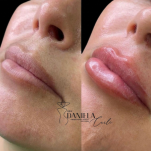Resultado de preenchimento labial com Dra. Daniela Carli em Curitiba