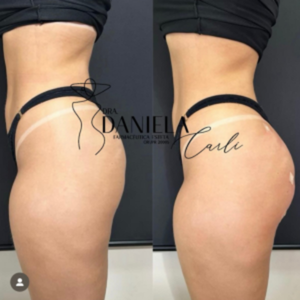 Resultado de tratamento estético corporal com Dra. Daniela Carli em Curitiba